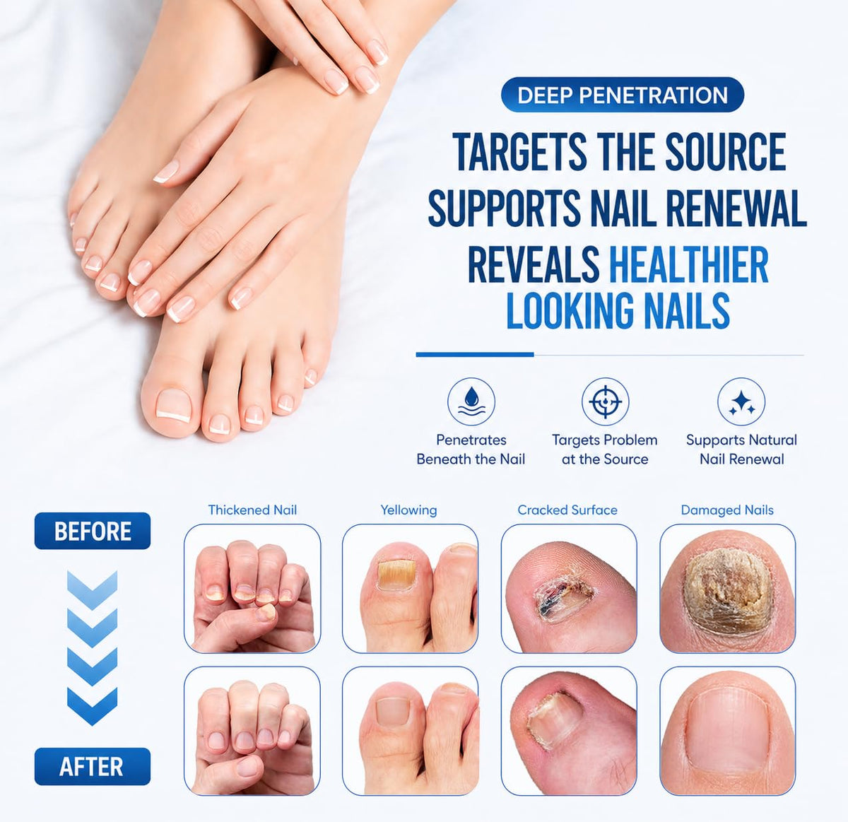 Nail Care Treatment Extra Strength with 25% Undecylenic Acid, 1.01 FLOZ