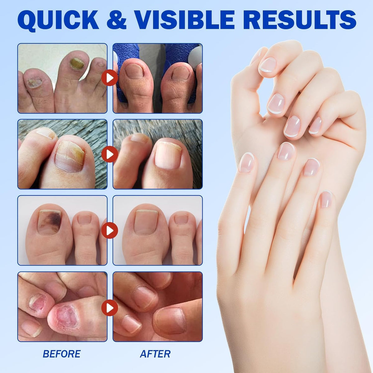 Nail Patches 42 PCS, Toenail Treatment Extra Strength 8-Hour Overnight Nail Fast Acting Repair Effortless Hydrogel Nail 
