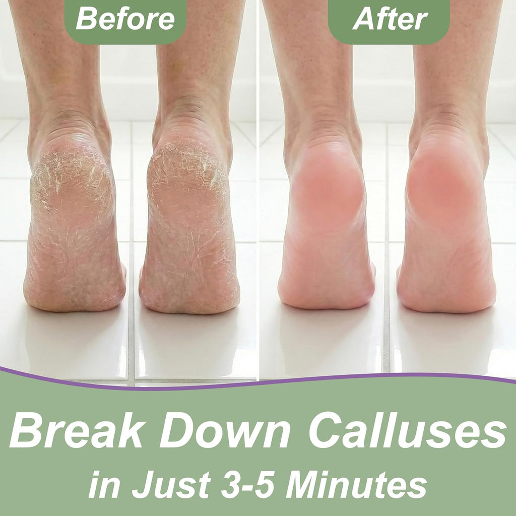 Callus Remover for Feet (Extra Strength 8 oz) Foot Callus Remover Gel
