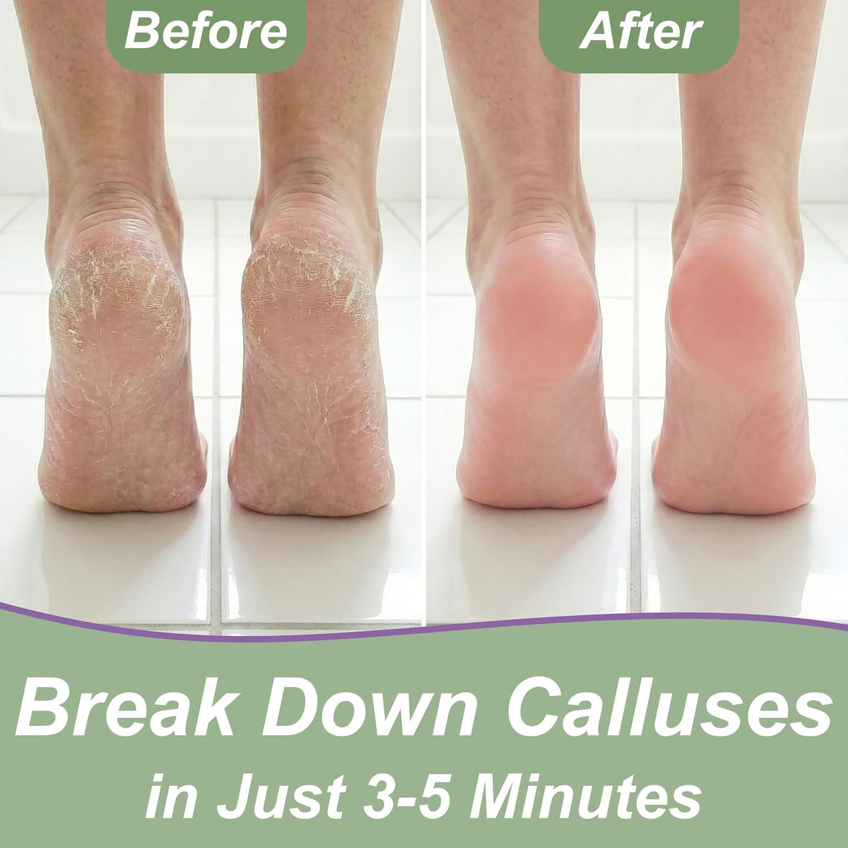 Callus Remover for Feet (Extra Strength 8 oz) Foot Callus Remover Gel